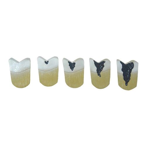 Dente Molar Ampliado Evolução Da Cárie Em 8 Parte